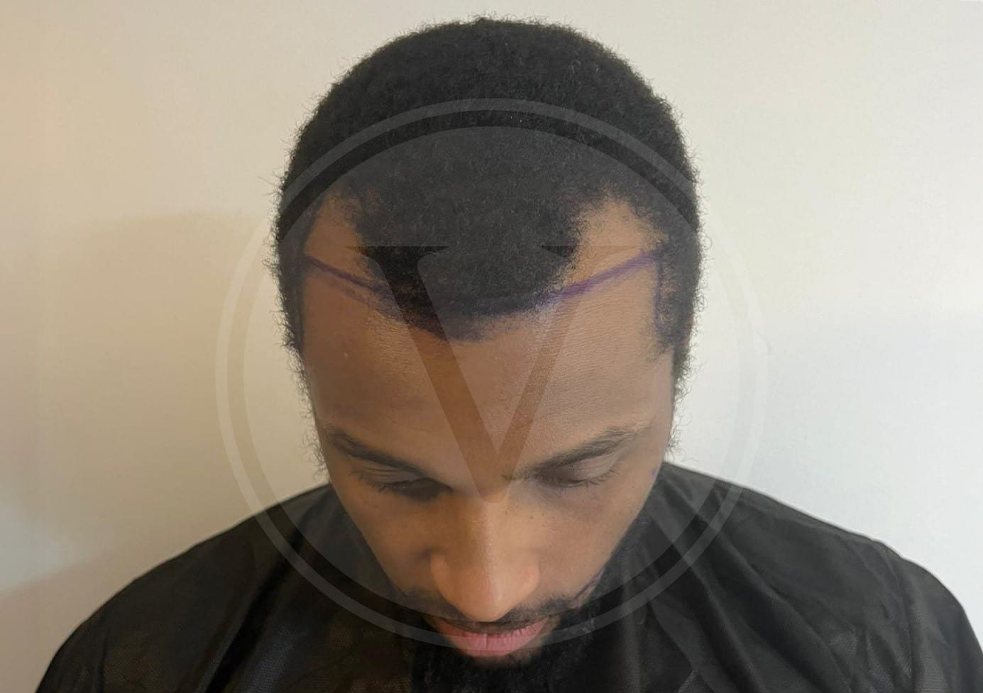 Afro Hair Transplant in Turkey – Istanbul Vita