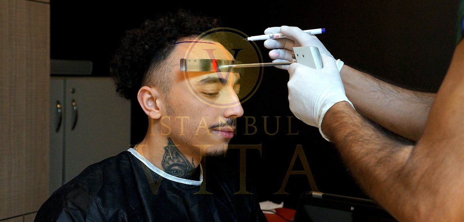 Istanbul Vita: Expert Care for Afro Hair Transplants